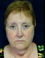 Facelift Before & After Facelift Before & After
