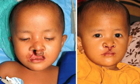 Cleft Lip Repair