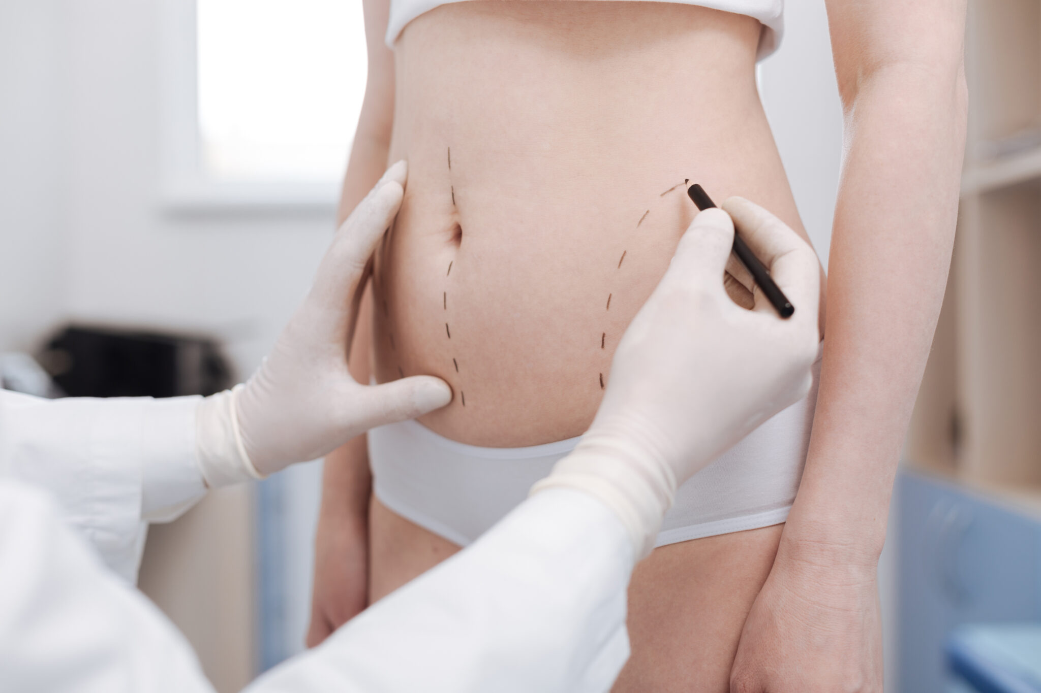 tummy tuck 